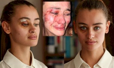 Ukraynalı model Daria Kyryliuk darp iddiasıyla ilgili ilk kez konuştu