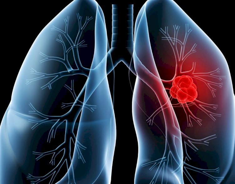 Türkiye akciğer kanseri görülme sıklığında ilk 10 ülke arasında