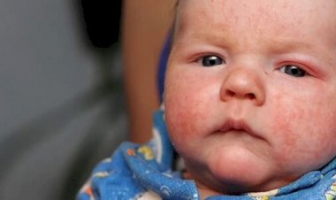 Çocuklarda Egzama Alevlenmeleri Polen Mevsiminde Artış Gösterebilir