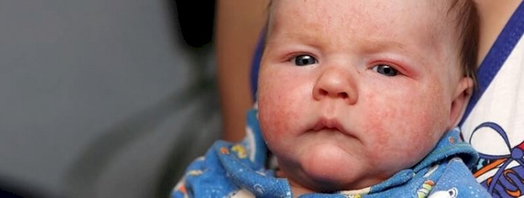 Çocuklarda Egzama Alevlenmeleri Polen Mevsiminde Artış Gösterebilir