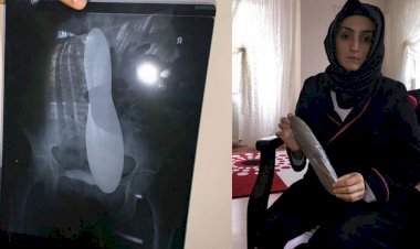 Ameliyat olan hastanın karnında 30 santimlik mala unuttular