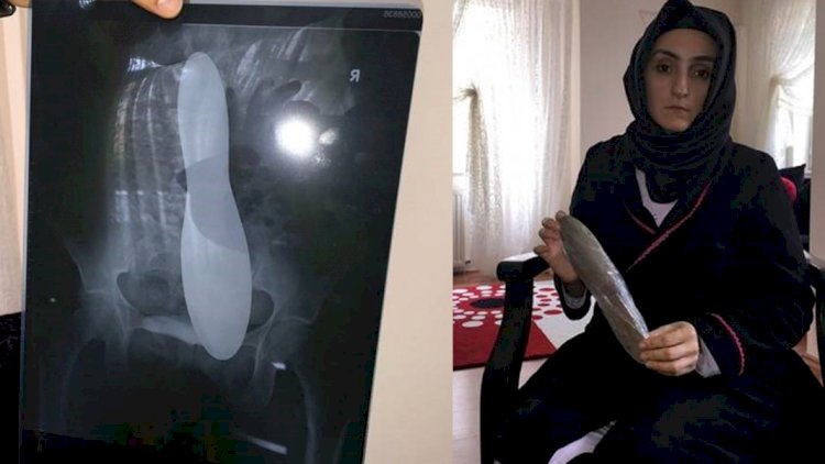 Ameliyat olan hastanın karnında 30 santimlik mala unuttular
