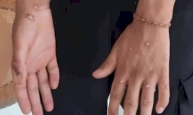 Maymun çiçeği virüsü: İstanbul'da üç kişi karantinaya alındı