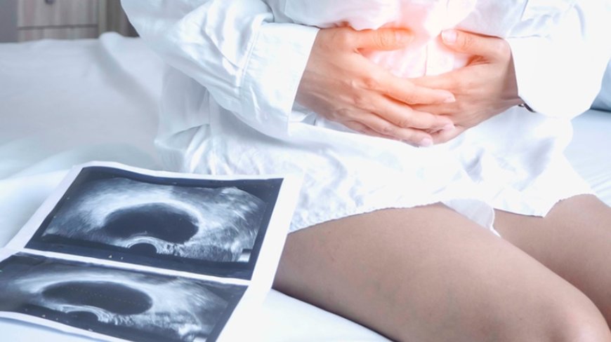 Yumurtalık Kisti Nedir? Belirtileri, Tedavi Yöntemleri ve Cerrahi Süreç