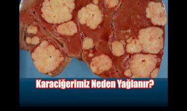 Karaciğer Yağlanmasına Ne İyi Gelir