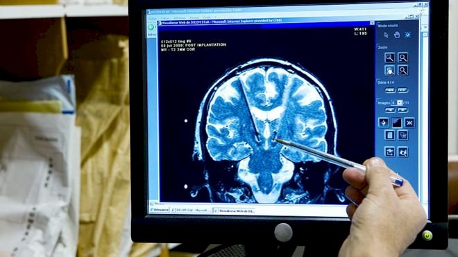 Çin'de Alzheimer için geliştirilen ilaca onay çıktı